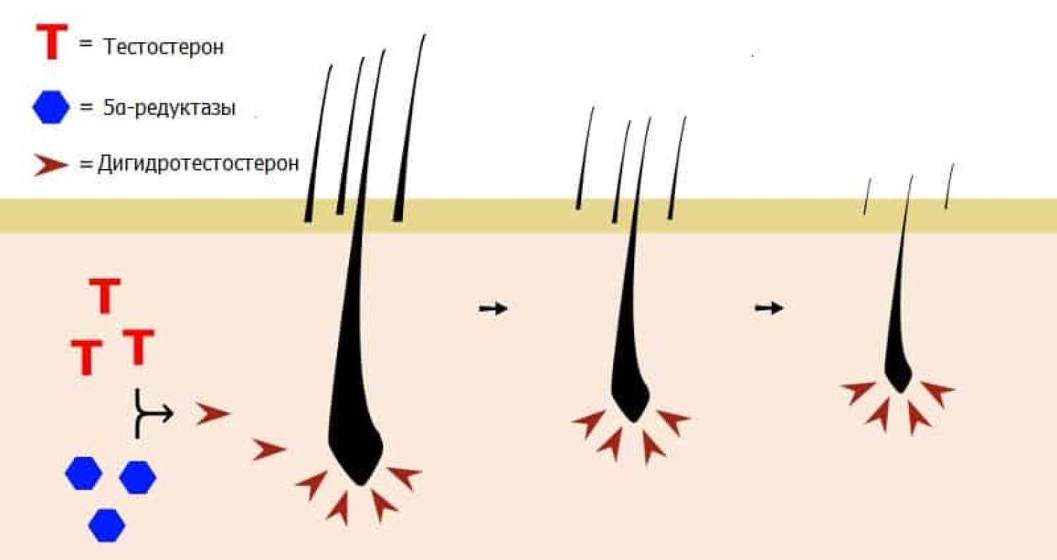 Влияние дигидротестостерона на волосяные луковицы