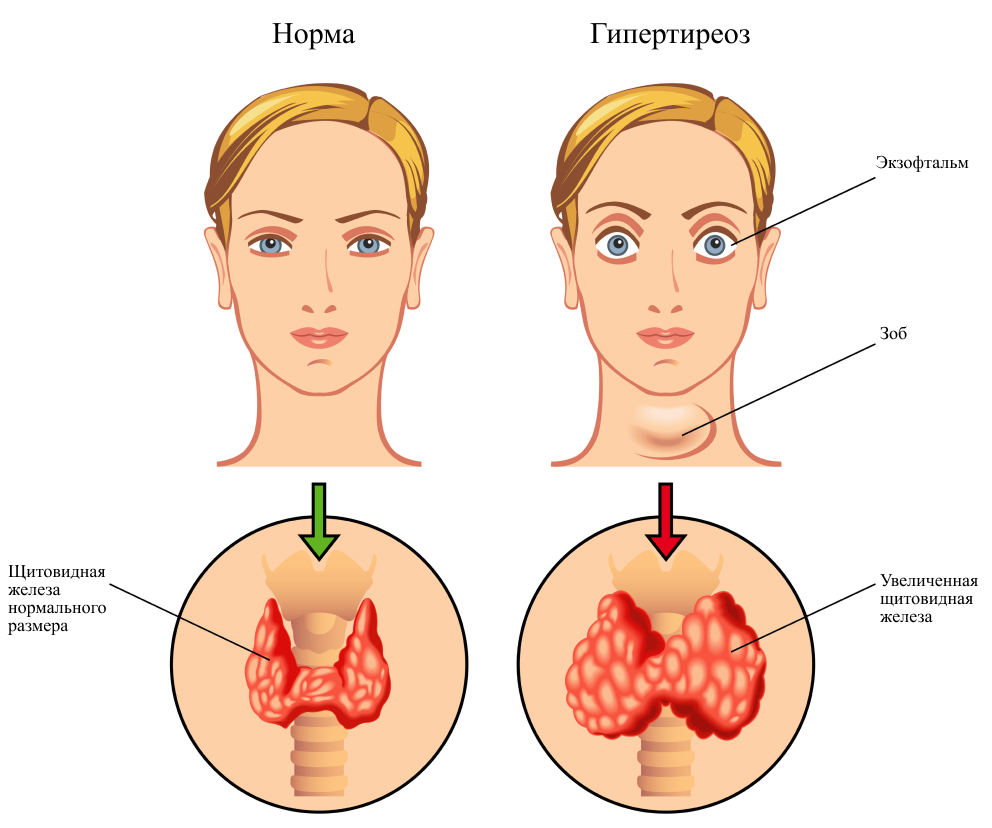 Норма и гипертиреоз