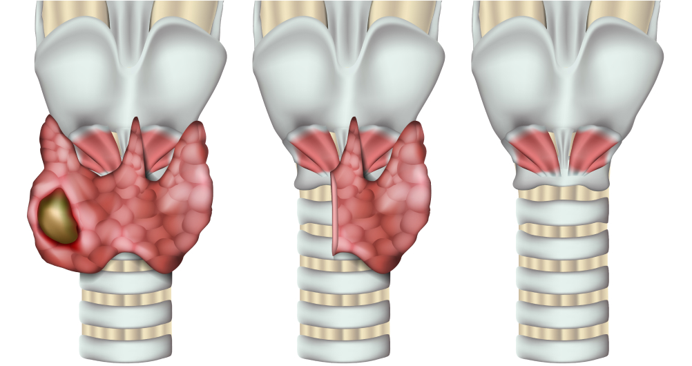 Тиреоидэктомия (слева изображено поражение раком, по центру - частичное удаление, справа - полное удаление)