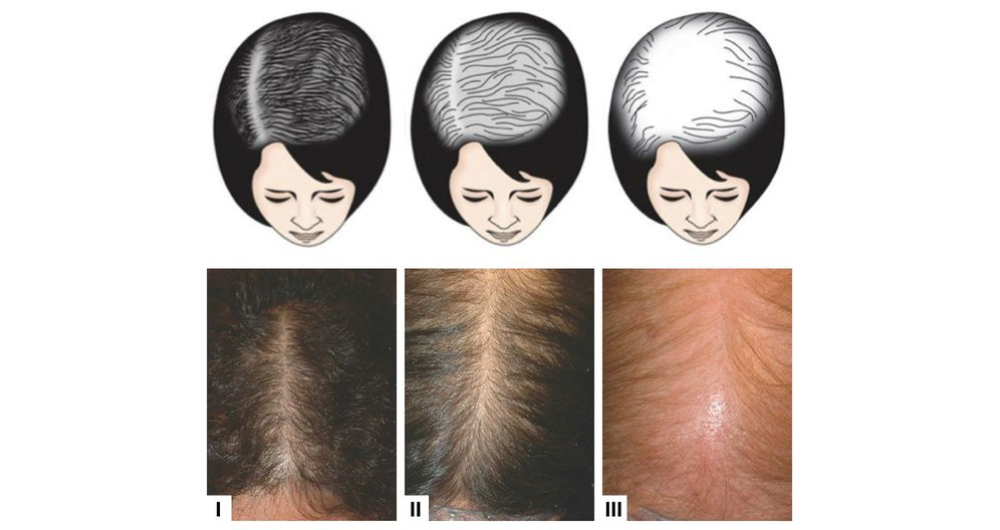 Выраженность потери волос у женщин по шкале Людвига