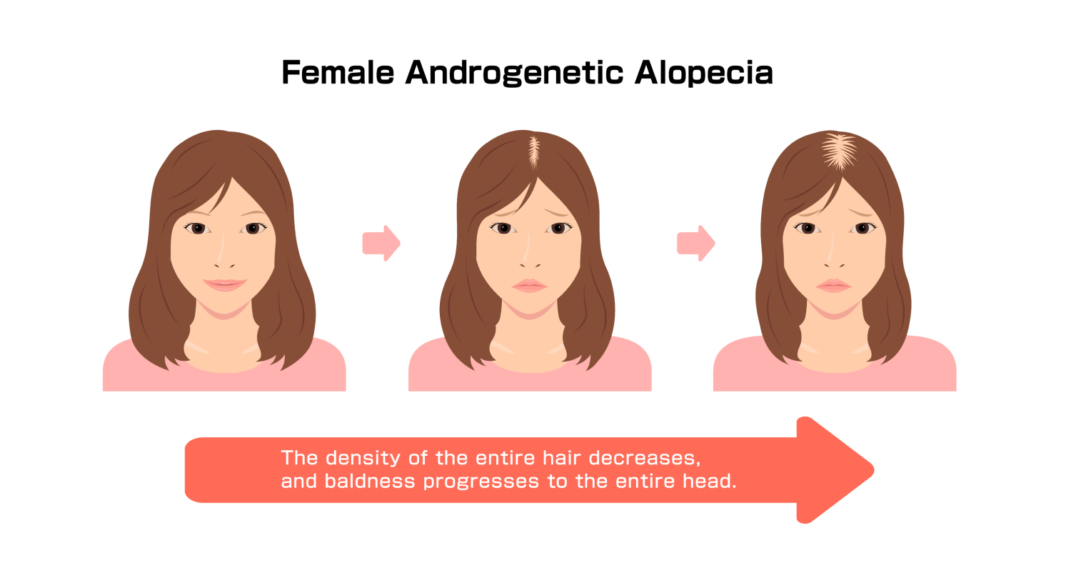 Женская андрогенетическая алопеция: уменьшается густота всех волос и облысение распространяется на всю голову